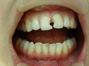 11 21 зубы до лечения после препарирования