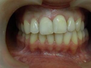 11 21 зубы после лечения